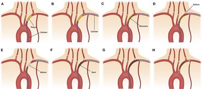 Combined Transradial and Transfemoral Approach With Ostial Vertebral Balloon Protection for the Treatment of Patients With Subclavian Steal Syndrome